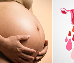 Graviditet med tvådelad eller delad livmoder