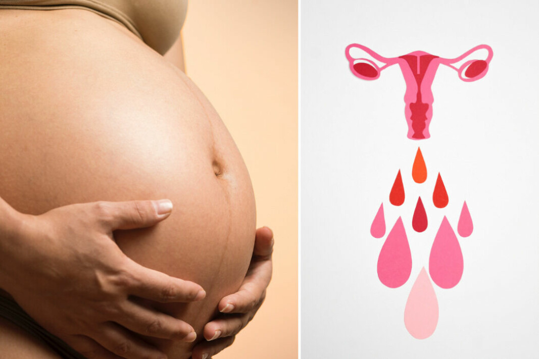 Kan man bli gravid med delad eller tvådelad livmoder?
